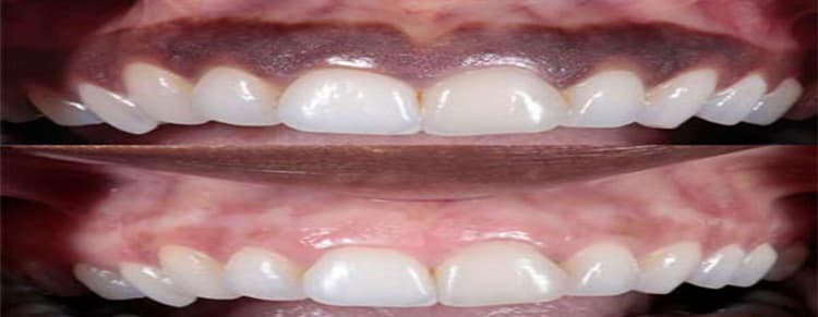 Depigmentation Of Gums