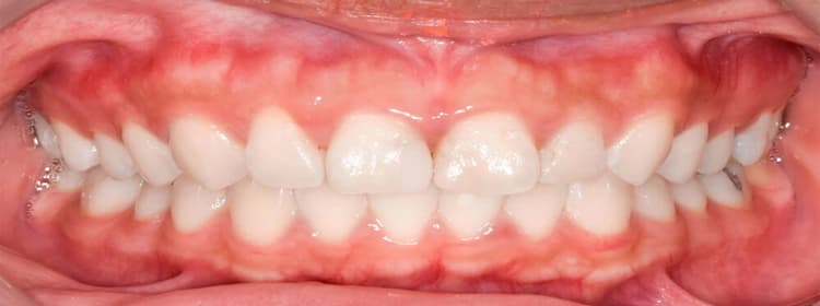 Frenectomy & Frenuloplasty