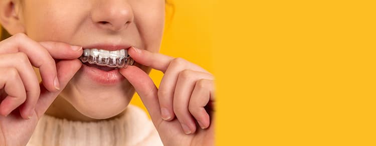 Invisalign
