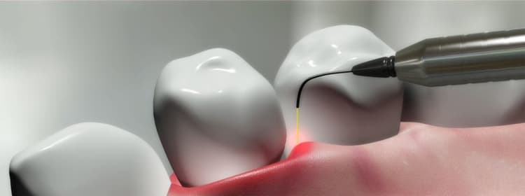 Laser Surgery
