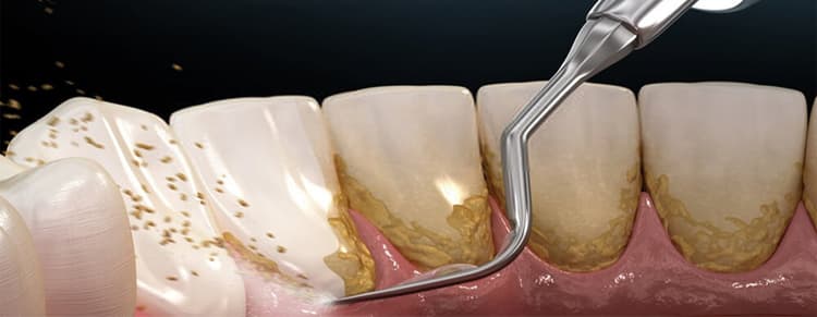 Ultrasonic Scaling