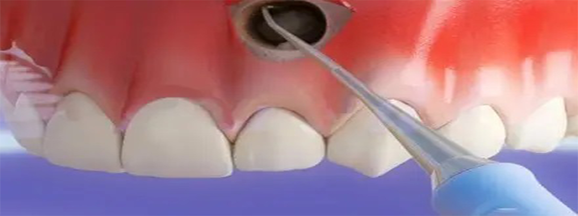 Apicoectomy Surgery