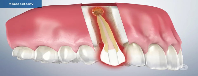 Apicoectomy Surgery