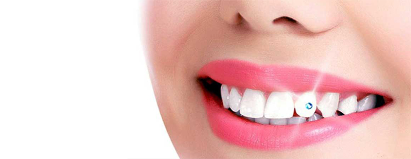 Dental Jewellery