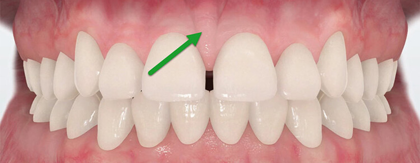 Frenectomy & Frenuloplasty