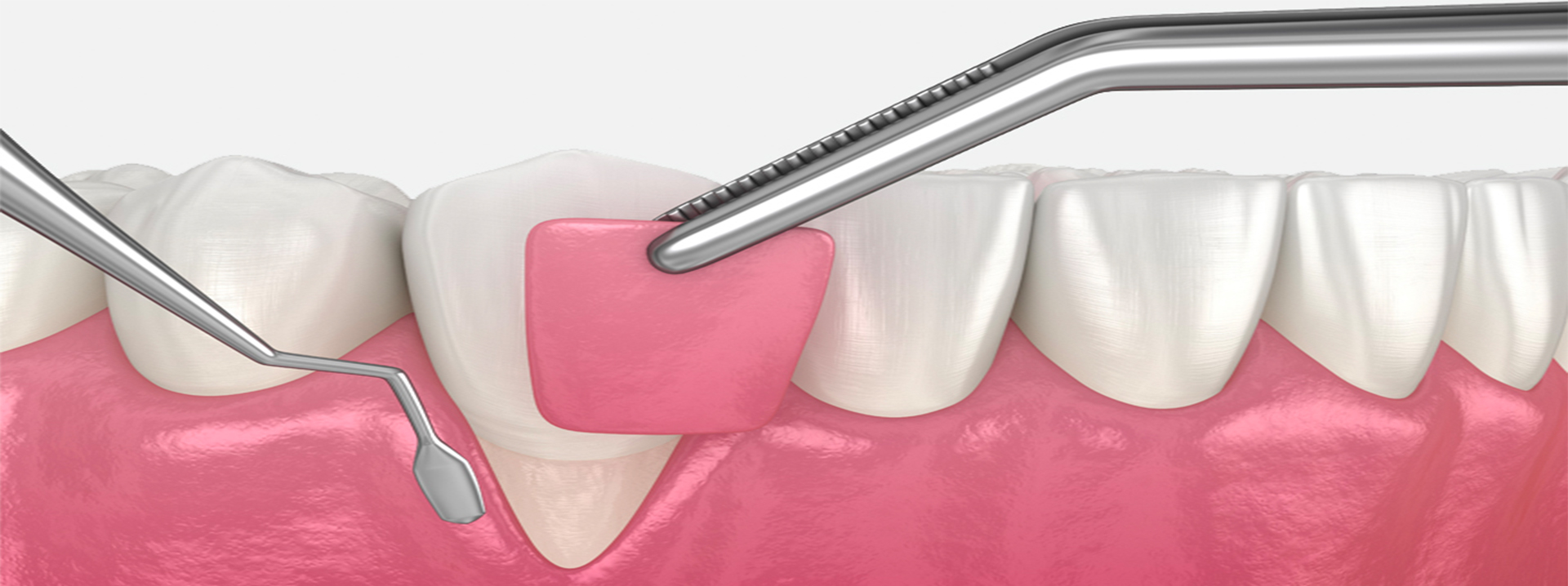 Gum Surgery & Periodontal Surgery