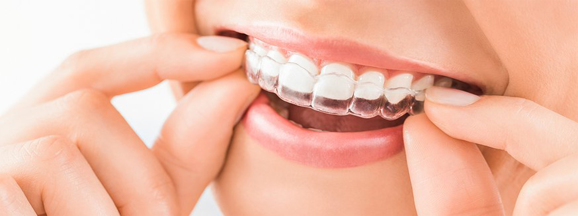 Invisalign