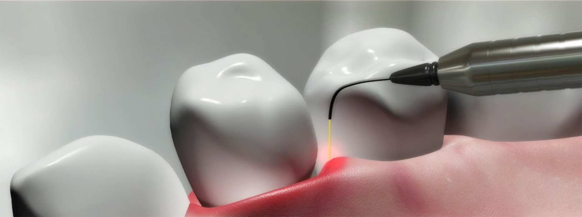 Laser Surgery
