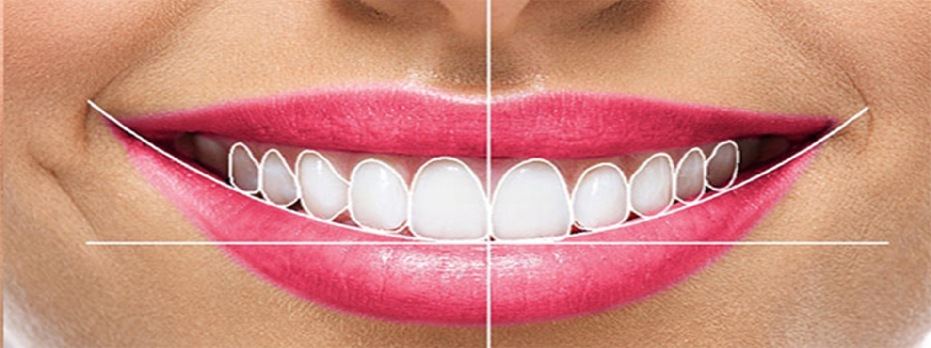 Smile Designing