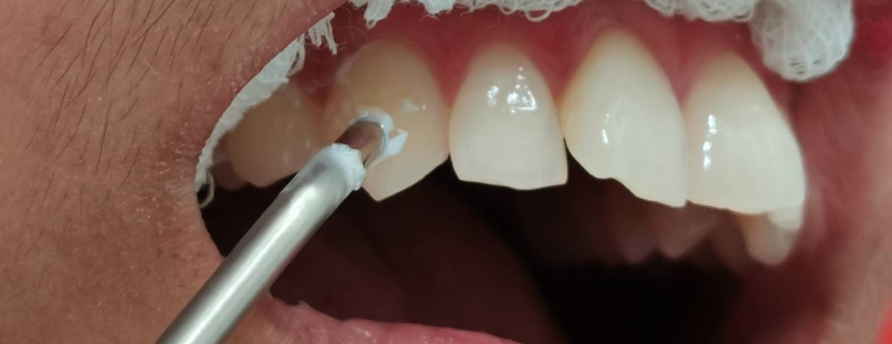 Tooth Vitality Test