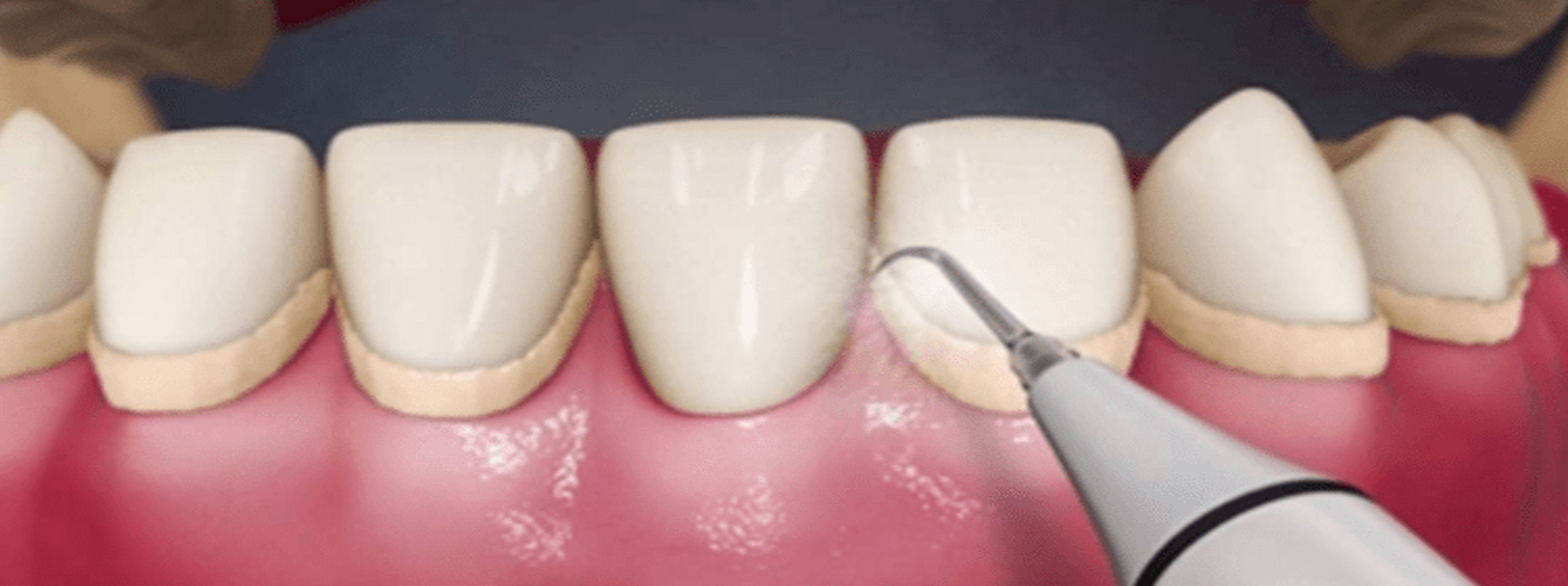 Ultrasonic Scaling