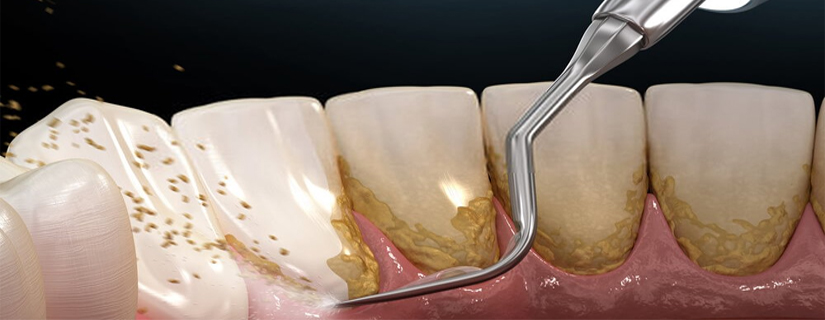 Ultrasonic Scaling