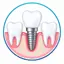 Best Tooth or Dental Implant Service in Kolkata